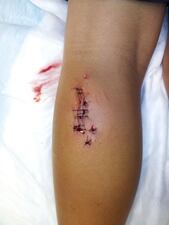 Connor Baker, 9, is recovering after being bitten by what is believed to be a shark in St. Augustine Beach.